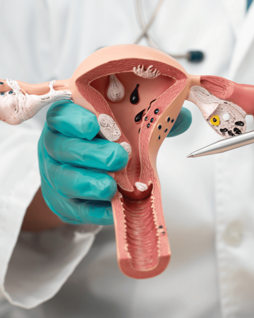 Doctor showing female reproductive system model to explain endometriosis and fertility care at EPIA